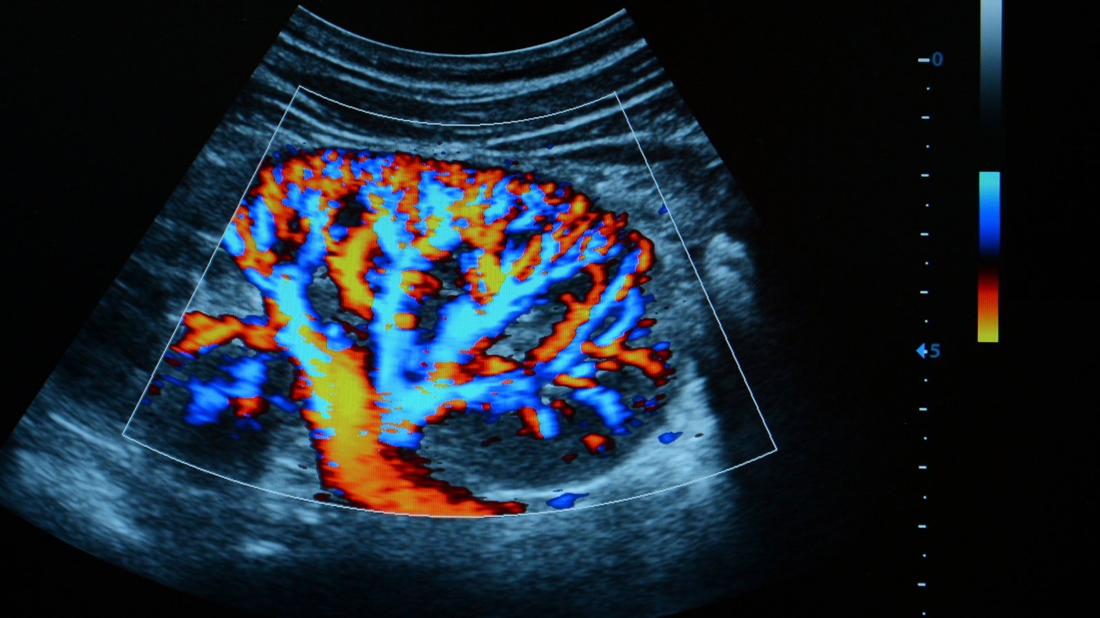 Prevenção de Doenças Vasculares com o Doppler Colorido de Aorta e Ilíacas | Dr. Leonardo Pacheco