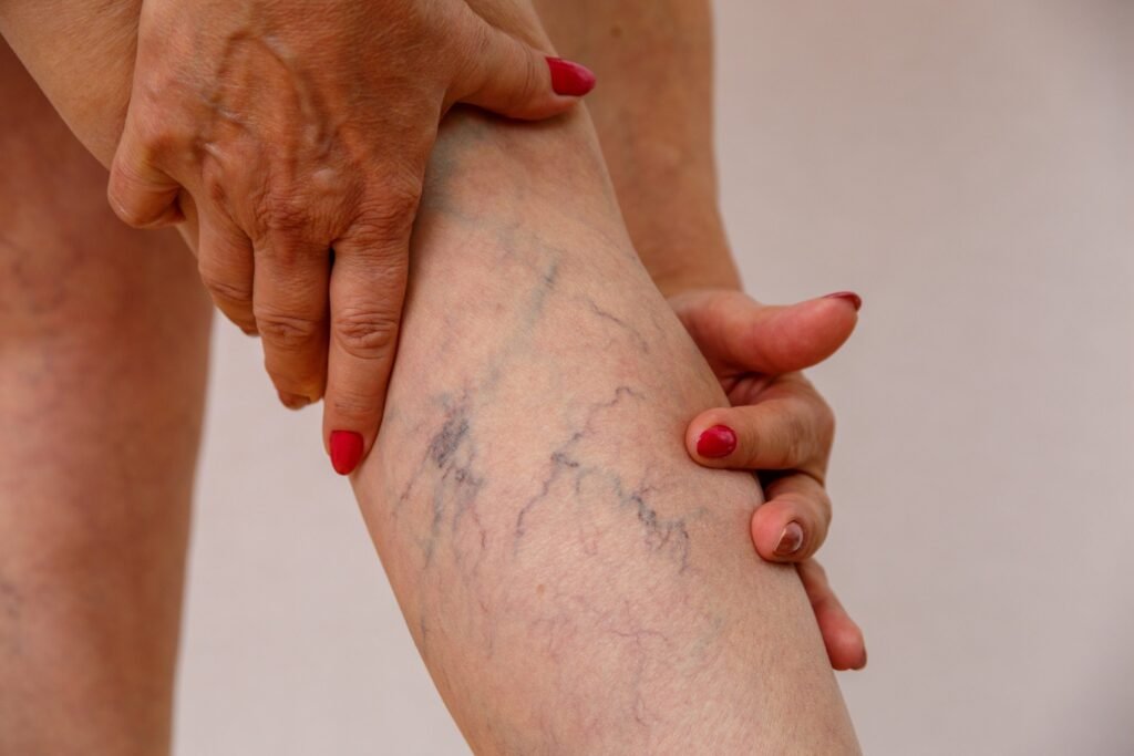 Varizes | Dr. Leonardo Pacheco