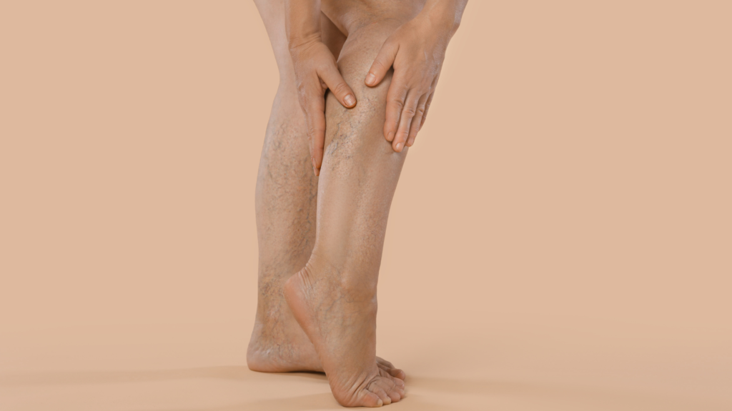Edema nas Pernas: 7 Causas Vasculares e Quando se Preocupar | Angioclínica